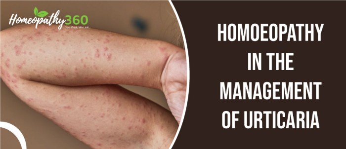 Hives causes symptoms lybrate